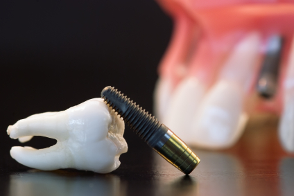 Имплантация зубов в Северном Бутово