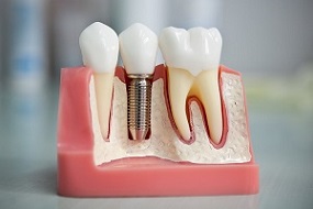 Имплантация зубов в Бутово